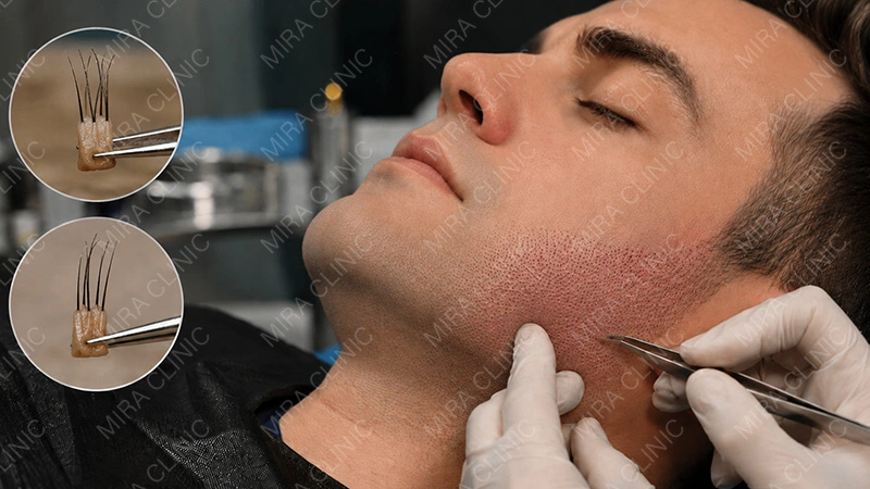 Multi-hair grafts